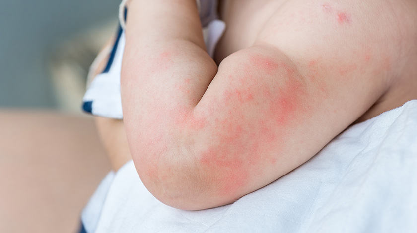5-simple-ways-to-manage-baby-rash
