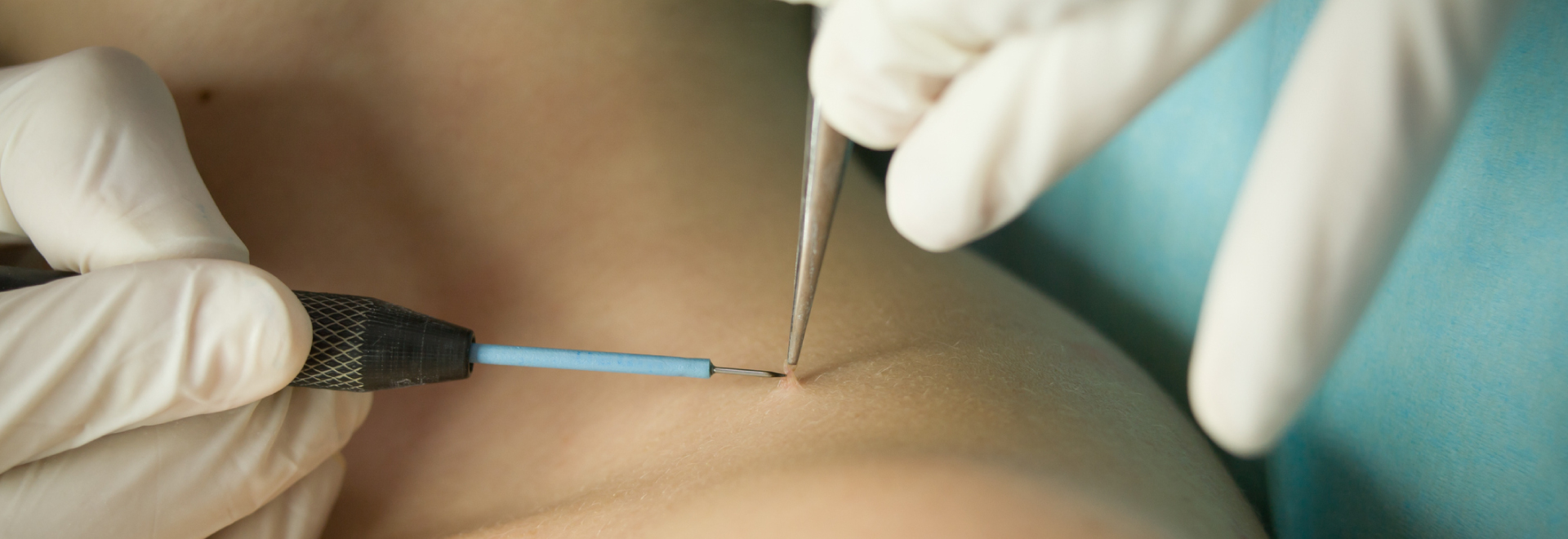 case-of-skin-warts
