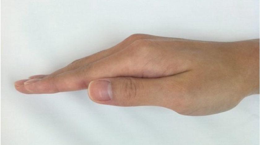 de-quervains-tenosynovitis-causes-symptoms-and-prevention