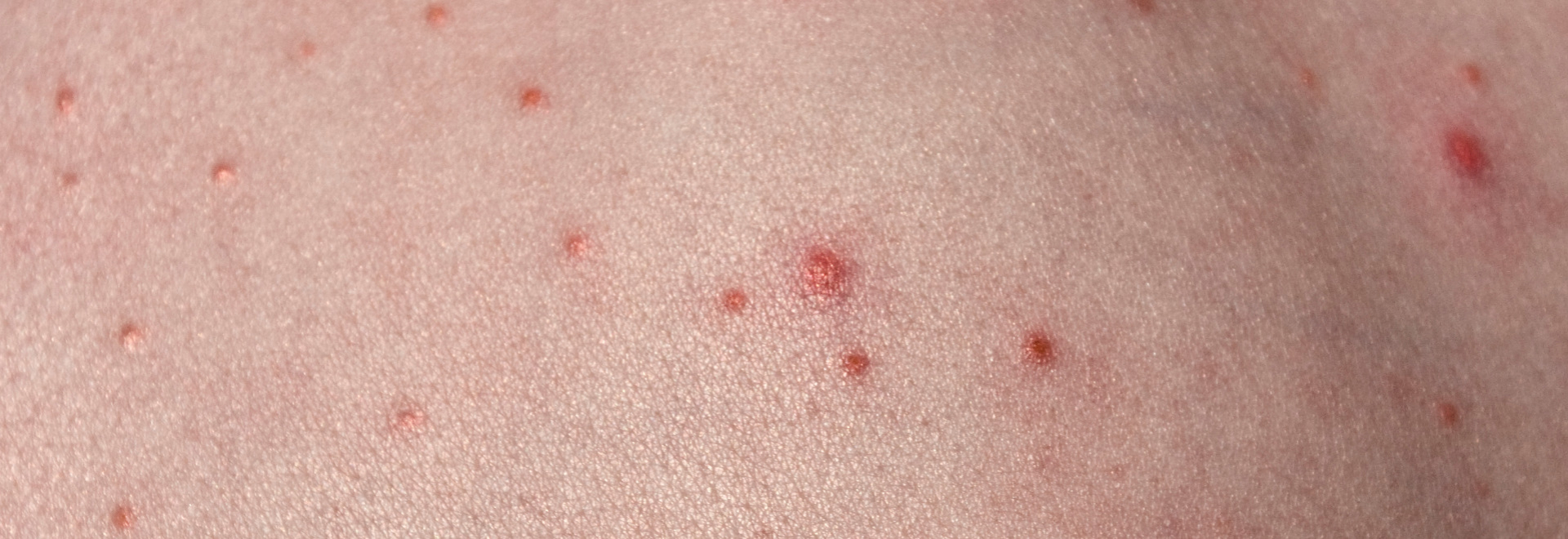 folliculitis-causes-symptoms-treatment