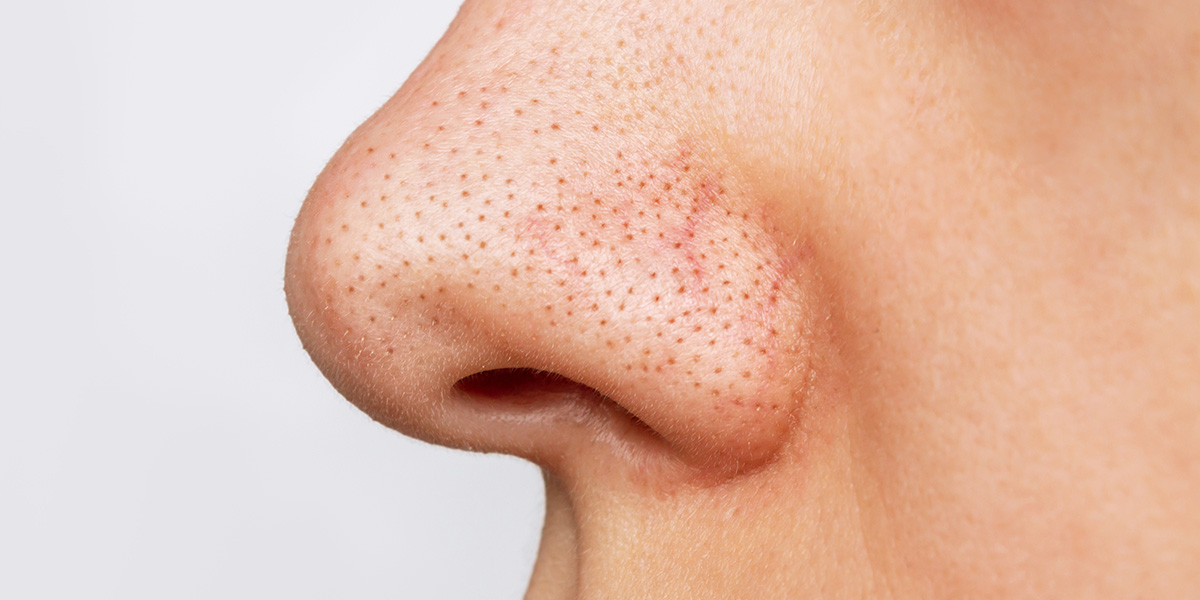 How to Get Rid of Blackheads and Whiteheads