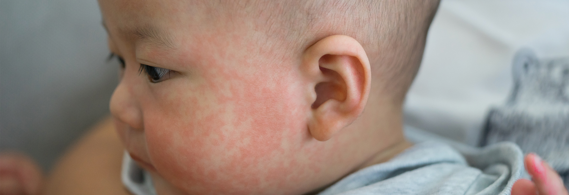 kawasaki-disease-causes-symptoms-treatment-side-effects