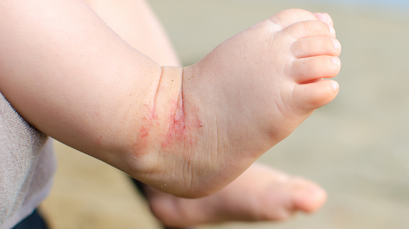 managing-childhood-eczema