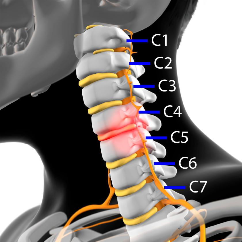 Neck Injuries Causes Symptoms Treatment