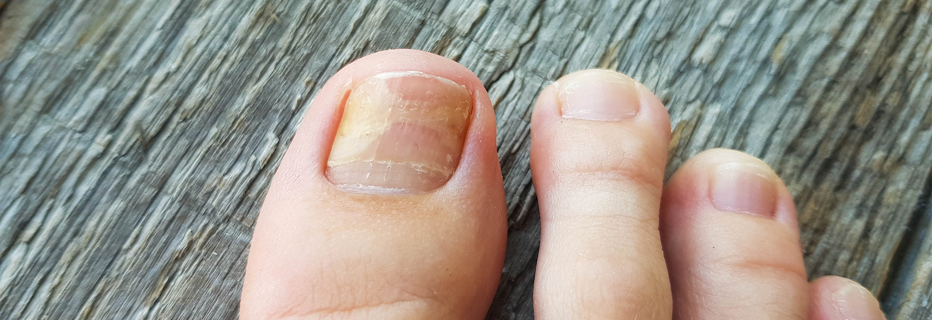 onychomycosis-fungal-nails-treatments-prevention-tips