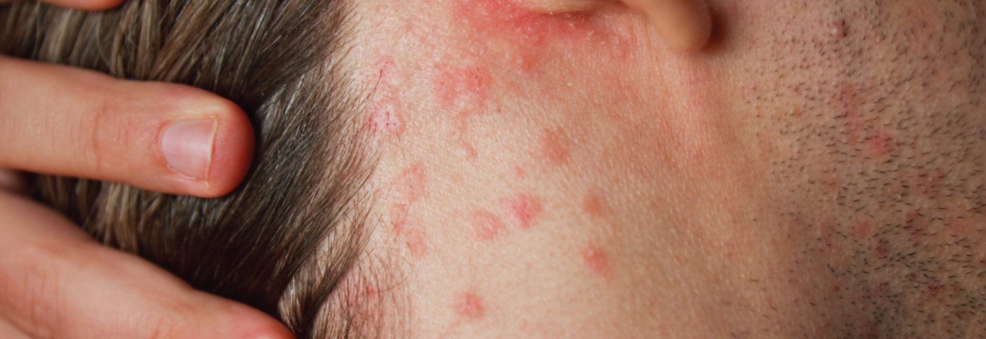 psoriasis-causes-symptoms-treatment