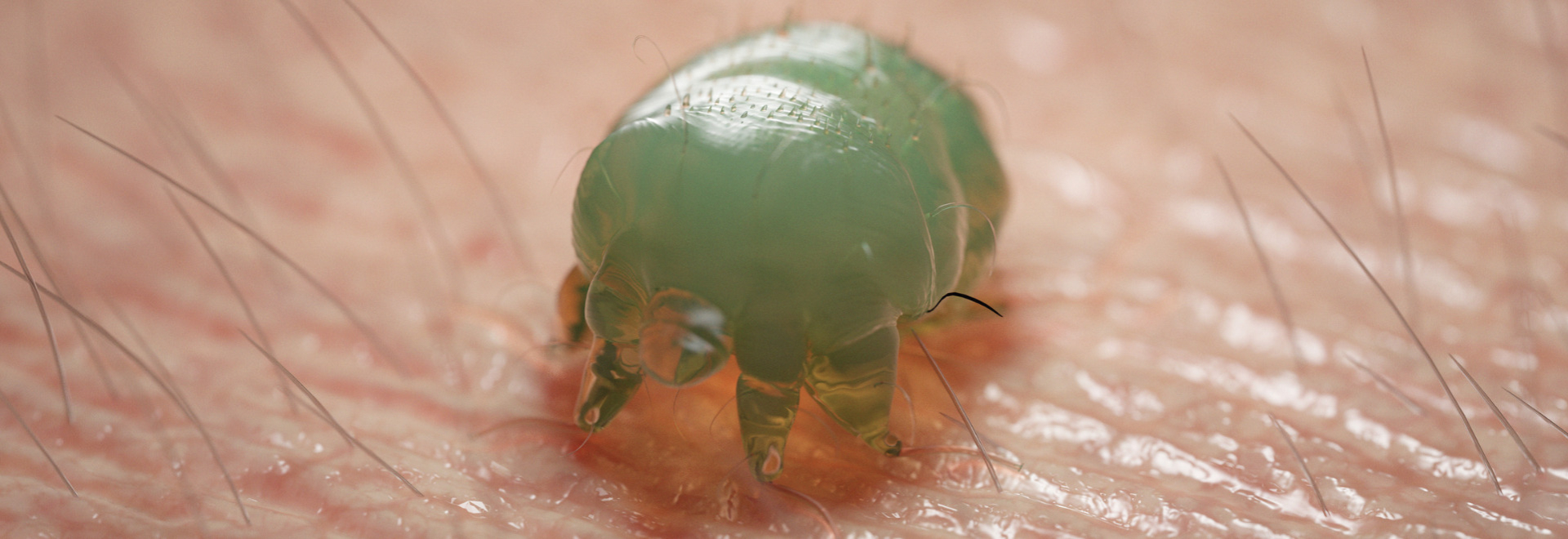 scabies-causes-symptoms-treatment-prevention