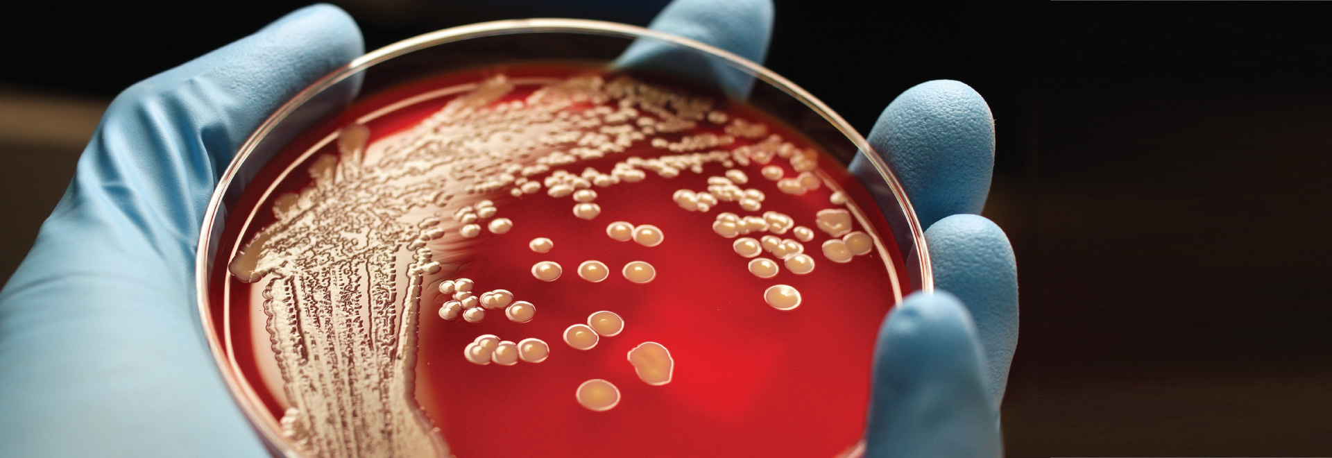 staphylococcus-aureus-infection-causes-symptoms-prevention-dsk