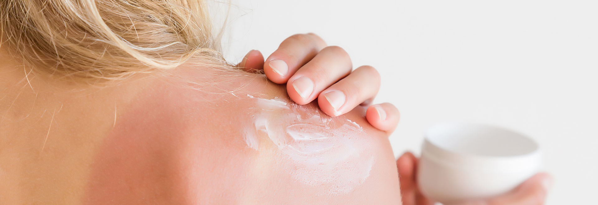 sunburn-causes-skin-treatment-tips
