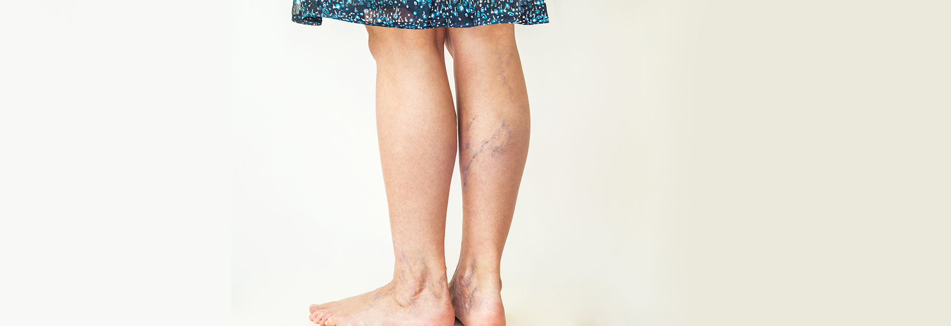 varicose-veins-causes-symptoms-treatment-and-prevention