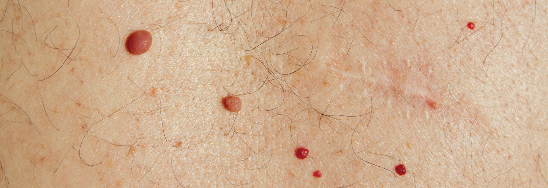 cherry-angioma-causes-symptoms-prevention-treatment
