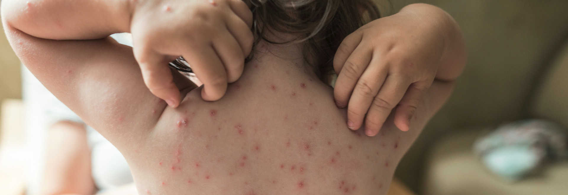 chickenpox-causes-symptoms-treatment