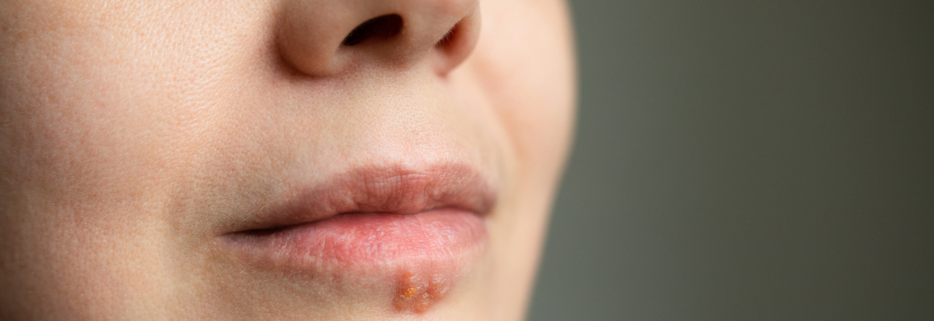 cold-sore-causes-symptoms-treatment