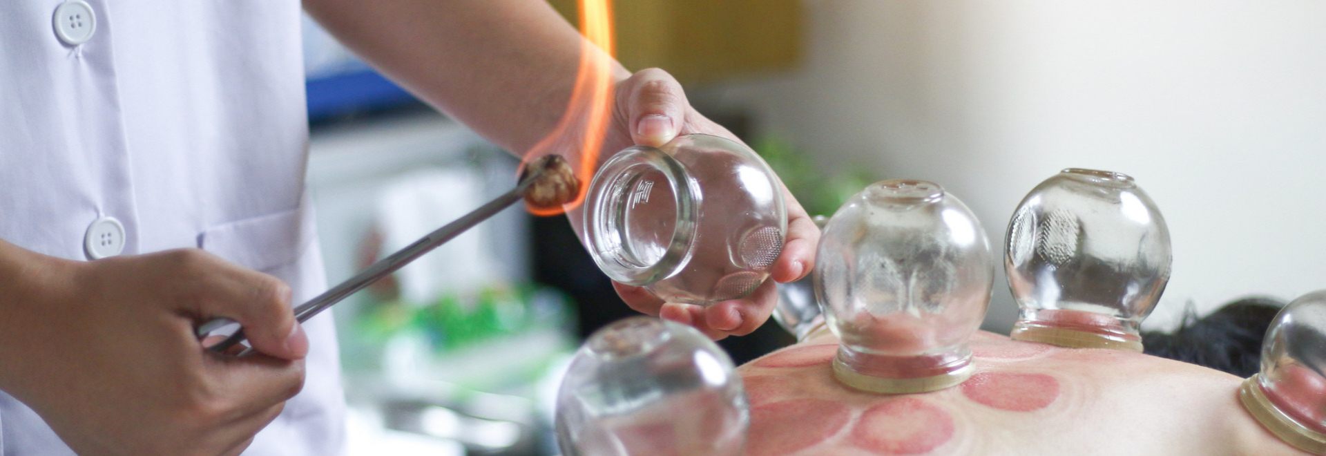 cupping-therapy-benefits-things-to-know-and-side-effects