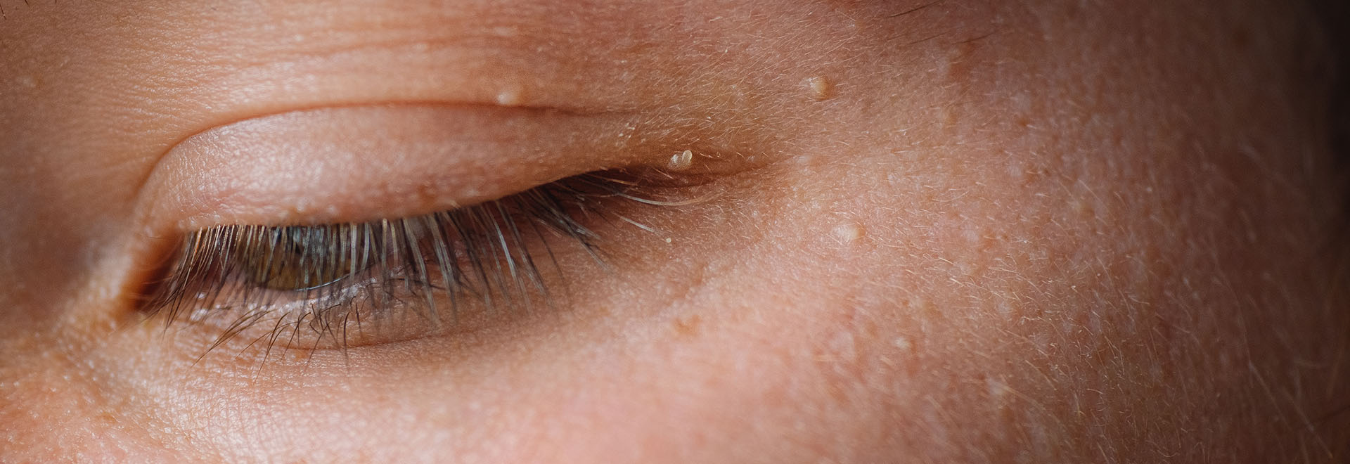 how-to-get-rid-of-fat-granules-on-face-in-summer